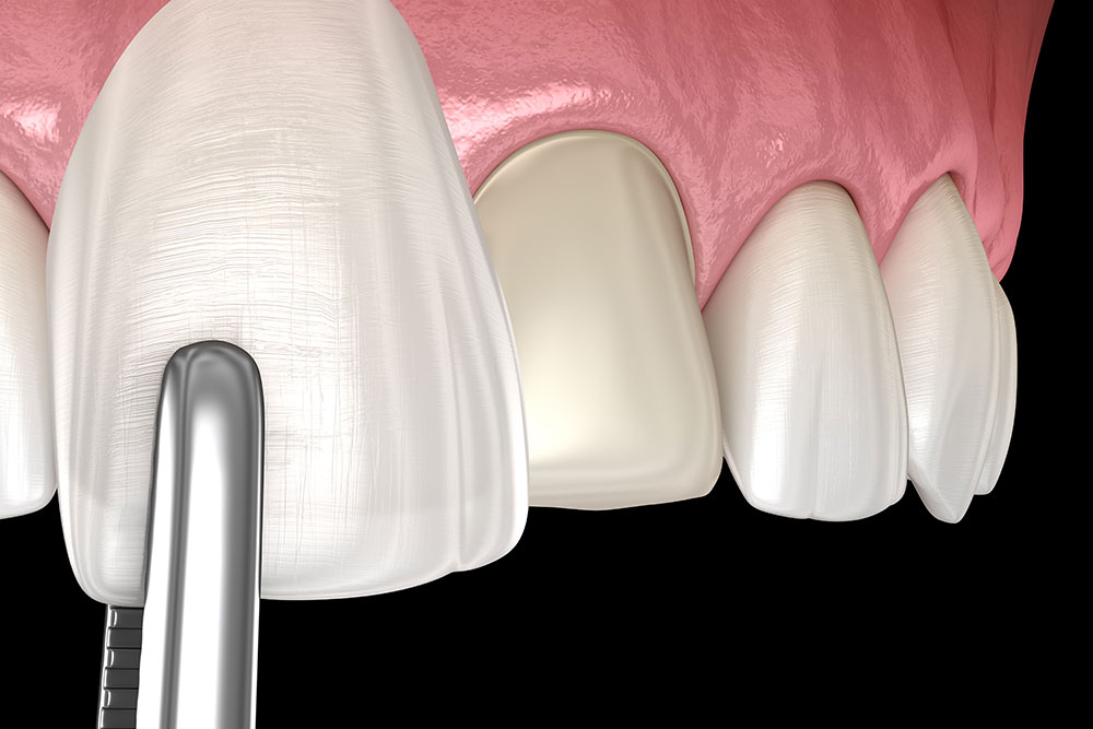 Porcelain Restorations