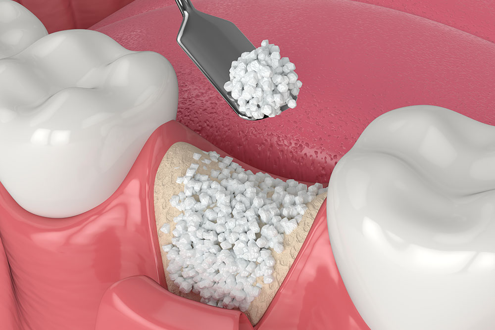 Bone Grafting