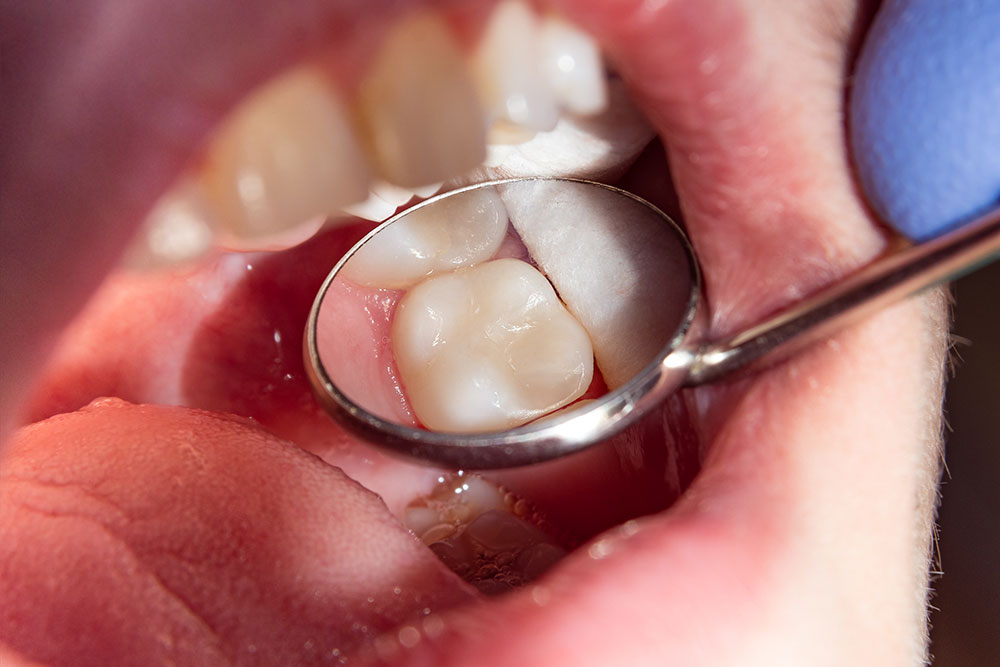 How To Care For Dental Fillings - Etwall Dental Practice